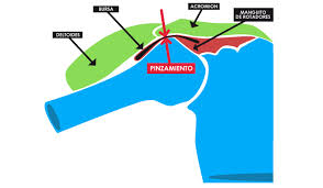 pinzamiento sub..2