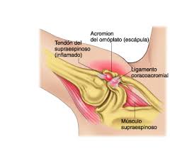pinzamiento sub..
