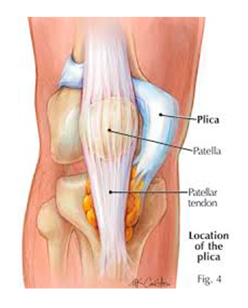 Plica Sinovial (3)