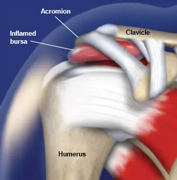 Subacromial-Bursitis