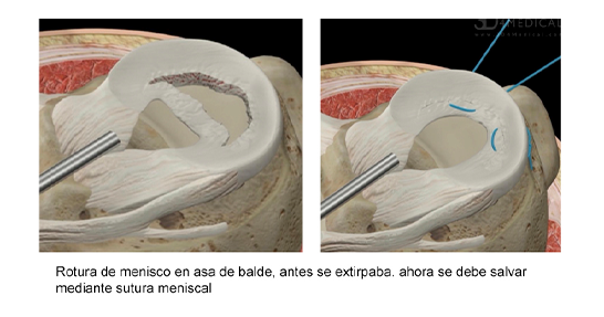 sutura meniscal sec