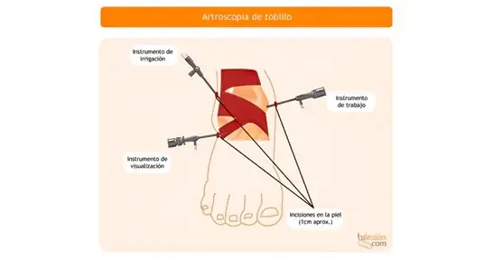 Prótesis-de-Hombro-(2)
